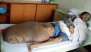 Китаец живет с 70-килограмовой опухолью на ноге [ФОТО НЕ ДЛЯ СЛАБОНЕРВНЫХ] 