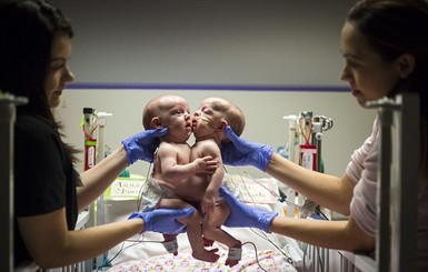 В США сиамских близнецов разделили спустя год после рождения