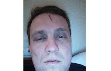 В Киевской области избили еще одного депутата