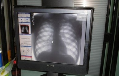 В Минздраве рассказали, как будут диагностировать туберкулез