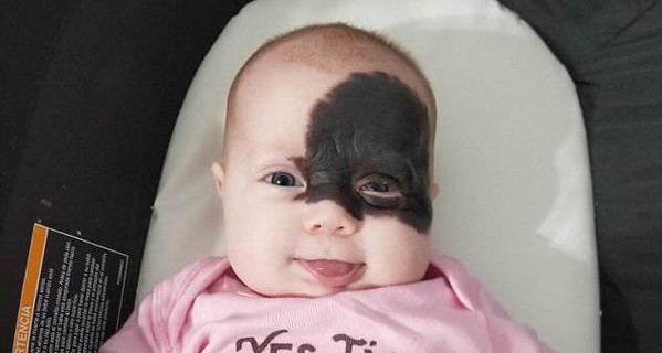 В США младенец появился на свет с родимым пятном, напоминающим маску Бэтмена 