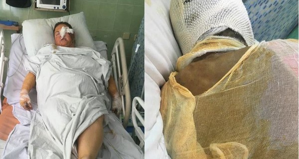 За информацию о напавшем на Гандзюк пообещали 100 тысяч гривен