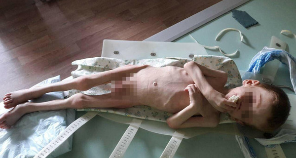 Шокирующая история в Новоукраинке: по дороге в больницу истощенный малыш просил: 