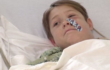 10-летний ребёнок в США проткнул голову шампуром и остался жив: подробности 