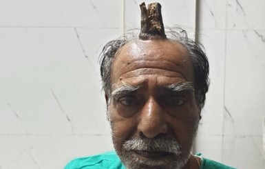 У индуса посреди головы вырос 10-сантиметровый рог