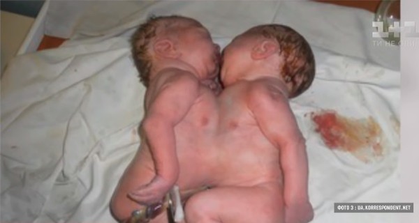 Сиамских близнецов из Черновцов переведут из роддома в областную детскую больницу