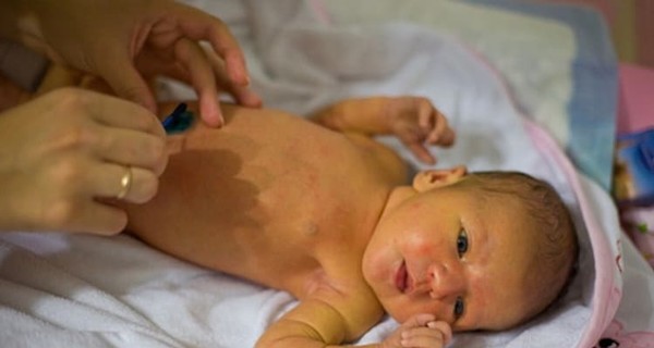 Физиологическая желтуха у новорожденных постхолецистэктомический синдром мкб