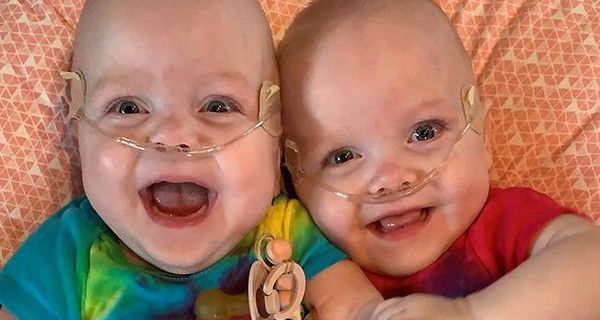 Cамые недоношенные близнецы в мире отпраздновали первый день рождения