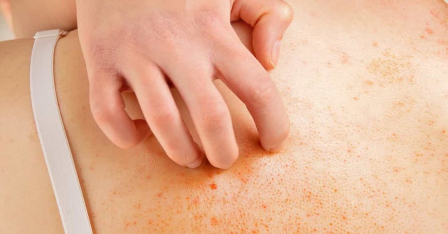 Аллергия на коже: причины, симптомы и лечение