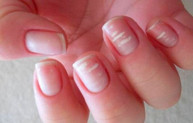 Белые пятна на ногтях: почему появляются и нужно ли лечить