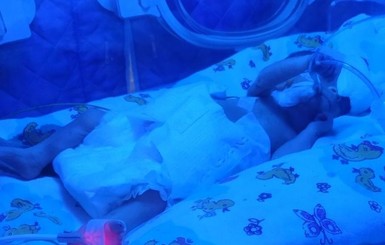 В Запорожье 16-летняя девушка родила малыша весом 690 грамм