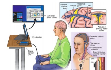 В Австралии человеческий мозг подключили к компьютеру через вену