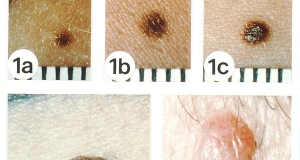 Меланома кожи фото и лечение