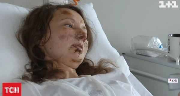 Постраждалу від російського обстрілу киянку перевели у палату доньки 