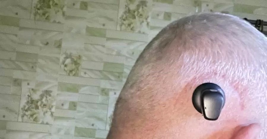 Львовские врачи вживили бойцу ВСУ слуховой аппарат в череп