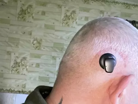 Львовские врачи вживили бойцу ВСУ слуховой аппарат в череп