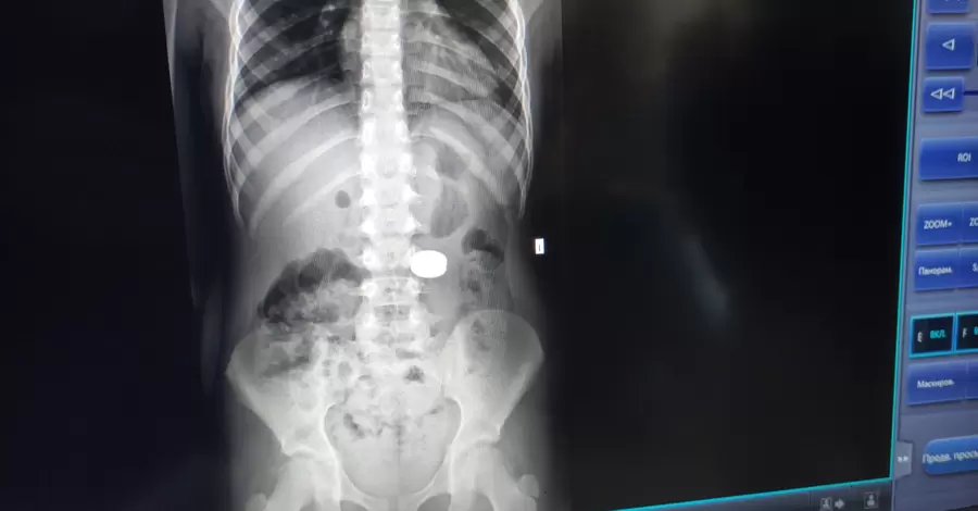 Во Львове врачи достали из желудка 7-летнего ребенка два магнита