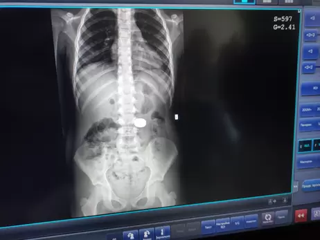 Во Львове врачи достали из желудка 7-летнего ребенка два магнита