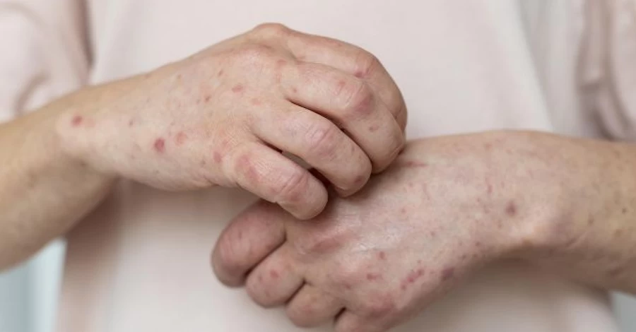 В Украине растет заболеваемость корью и ситуация может усложниться, - Центр общественного здоровья  