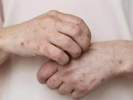 В Украине растет заболеваемость корью и ситуация может усложниться, - Центр общественного здоровья  