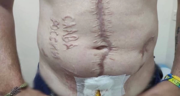 Фото украинского бойца с выжженной надписью «Слава России» сделал врач, - ГУР