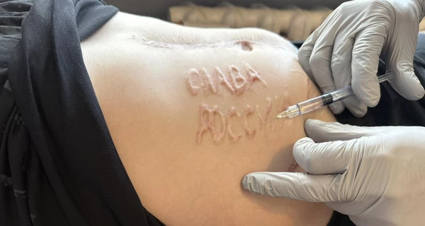 Военный, которому в плену выжгли «Слава России», хочет вернуться на службу