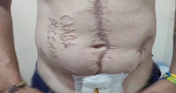 Лікарі показали, як відбувається лікування українського захисника з випаленим написом 