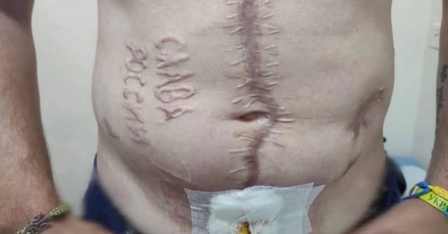 Лікарі показали, як відбувається лікування українського захисника з випаленим написом 