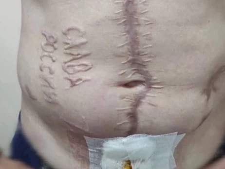 Лікарі показали, як відбувається лікування українського захисника з випаленим написом 