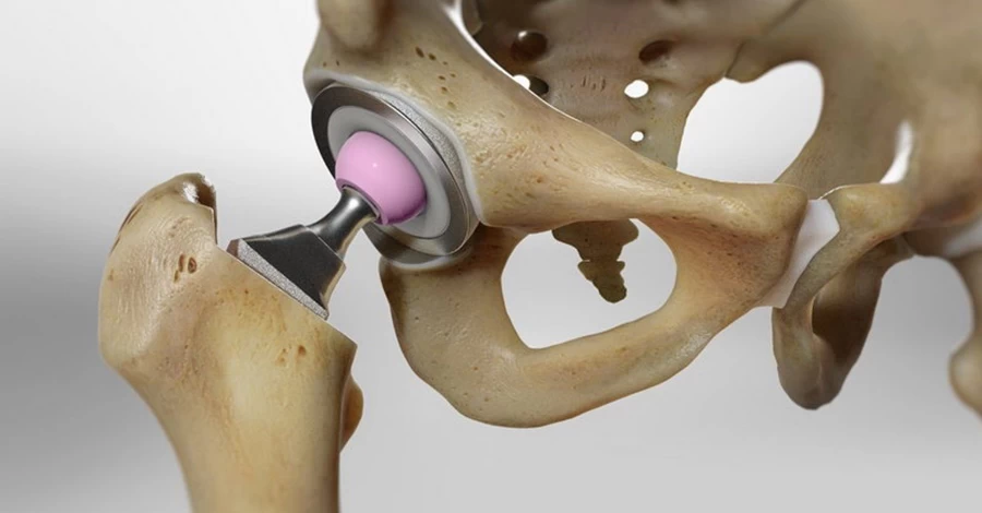 Не тільки вік: чому кульшовий суглоб доводиться міняти і в 30, і в 60 років