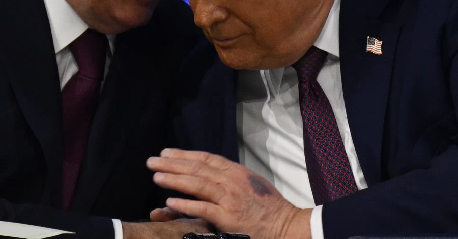 Трамп в Давосе объяснил происхождение синяка на руке