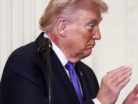 Лікар Трампа пояснив, звідки на його шиї великі червоні плями 