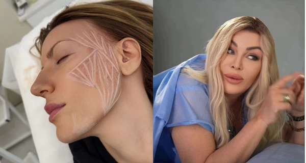 Краса майбутнього: Білик встановила імпланти для енергії, а Нікітюк робить уколи для стимуляції колагену 