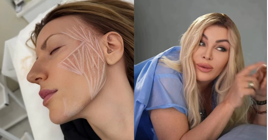 Краса майбутнього: Білик встановила імпланти для енергії, а Нікітюк робить уколи для стимуляції колагену 