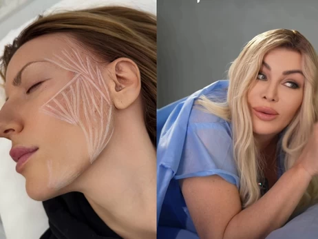 Красота будущего: Билык установила импланты для энергии, а Никитюк делает уколы для стимуляции коллагена 