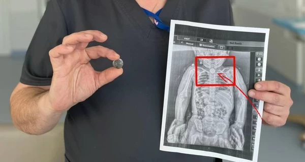 Львівські хірурги врятували 2-річну дівчинку, яка всю зиму прожила із батарейкою в стравоході