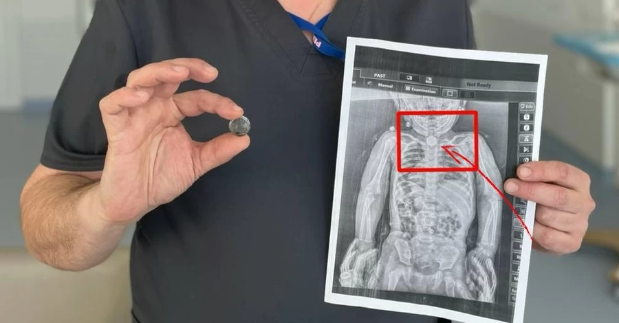 Львівські хірурги врятували 2-річну дівчинку, яка всю зиму прожила із батарейкою в стравоході